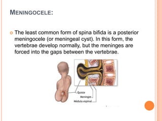 MENINGOCELE:
 The least common form of spina bifida is a posterior
meningocele (or meningeal cyst). In this form, the
vertebrae develop normally, but the meninges are
forced into the gaps between the vertebrae.
 