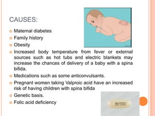 CAUSES:
 Maternal diabetes
 Family history
 Obesity
 Increased body temperature from fever or external
sources such as hot tubs and electric blankets may
increase the chances of delivery of a baby with a spina
bifida.
 Medications such as some anticonvulsants.
 Pregnant women taking Valproic acid have an increased
risk of having children with spina bifida
 Genetic basis.
 Folic acid deficiency
 