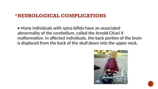 NEUROLOGICAL COMPLICATIONS
• Many individuals with spina bifida have an associated
abnormality of the cerebellum, called the Arnold Chiari Il
malformation. In affected individuals, the back portion of the brain
is displaced from the back of the skull down into the upper neck.
 
