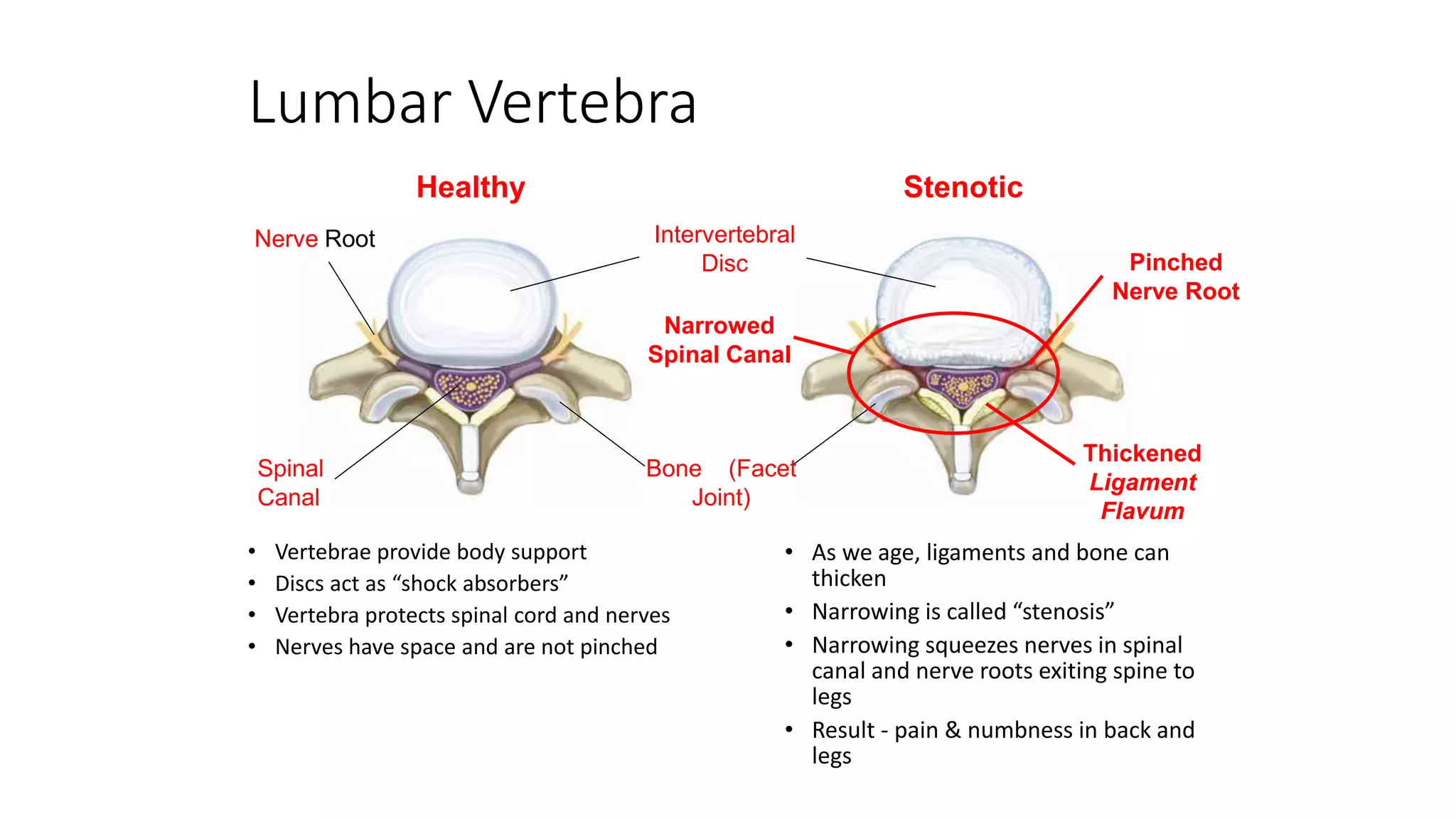Spinal canal stenosis | PPTX