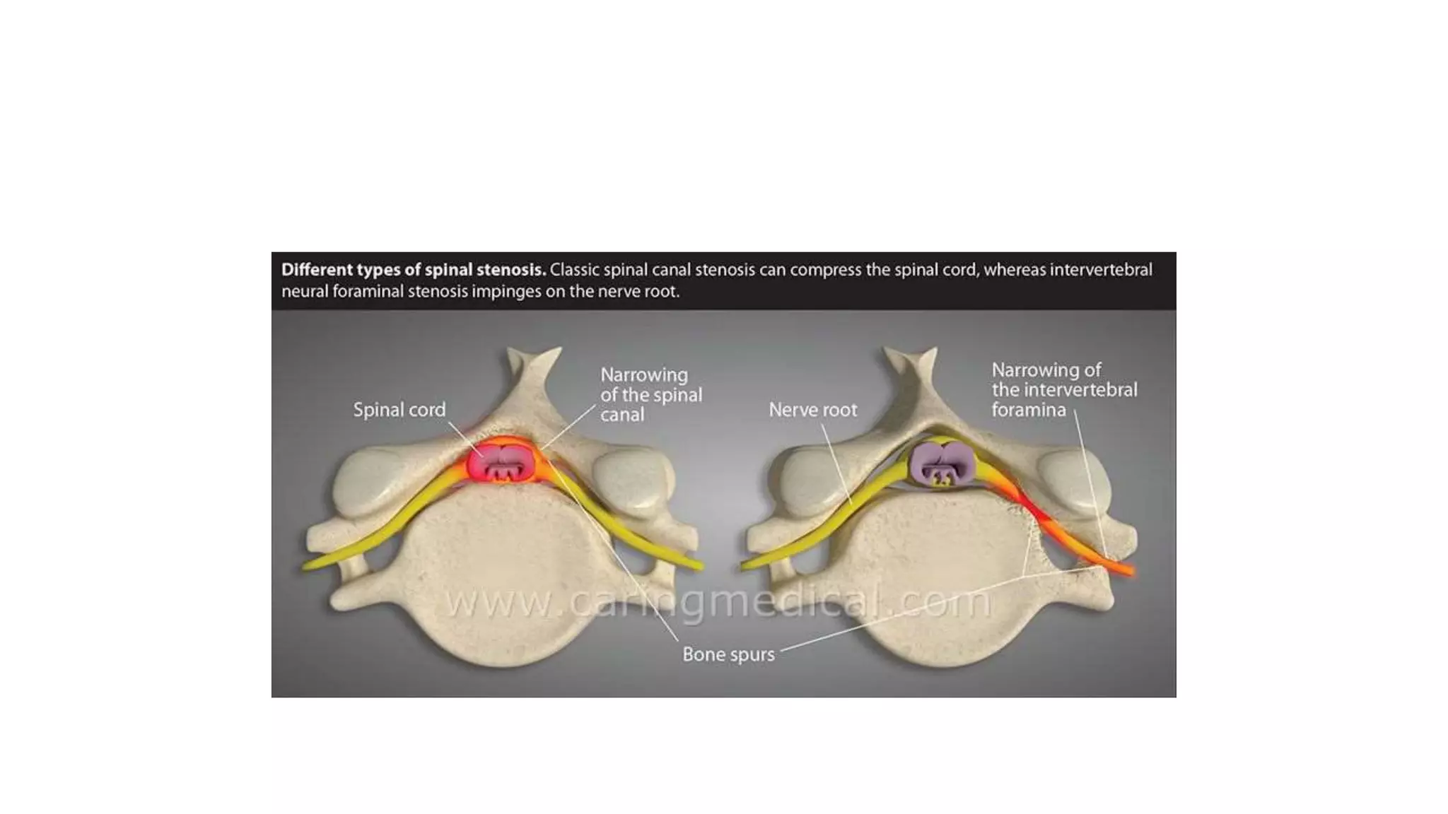 Spinal canal stenosis | PPTX