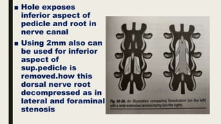 ■ Hole exposes
inferior aspect of
pedicle and root in
nerve canal
■ Using 2mm also can
be used for inferior
aspect of
sup.pedicle is
removed.how this
dorsal nerve root
decompressed as in
lateral and foraminal
stenosis
 