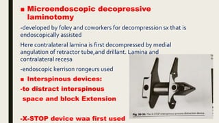 ■ Microendoscopic decopressive
laminotomy
-developed by foley and coworkers for decompression sx that is
endoscopically assisted
Here contralateral lamina is first decompressed by medial
angulation of retractor tube,and drillant. Lamina and
contralateral recesa
-endoscopic kerrison rongeurs used
■ Interspinous devices:
-to distract interspinous
space and block Extension
-X-STOP device waa first used
 
