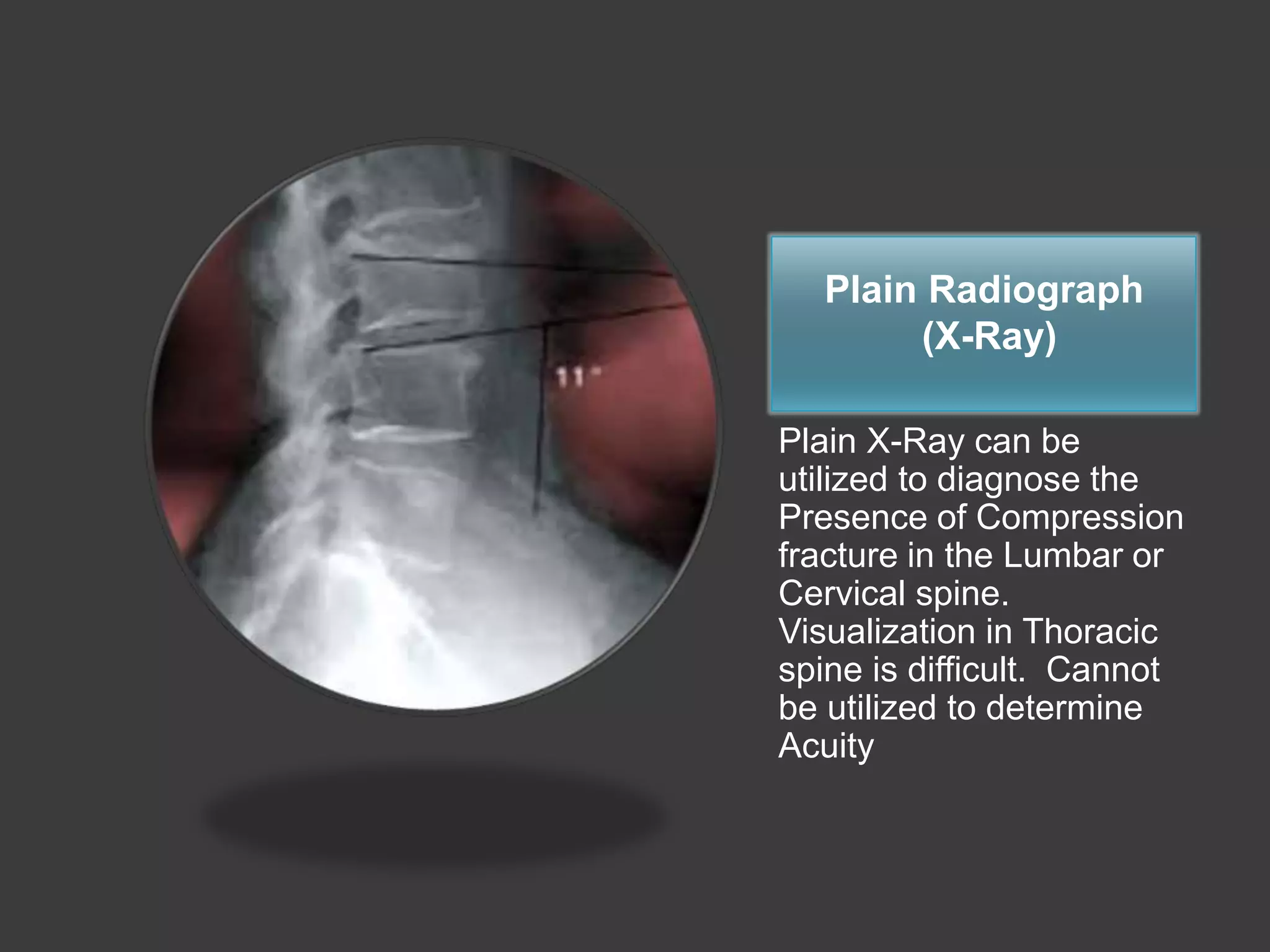 Spinal compression fractures | PPTX