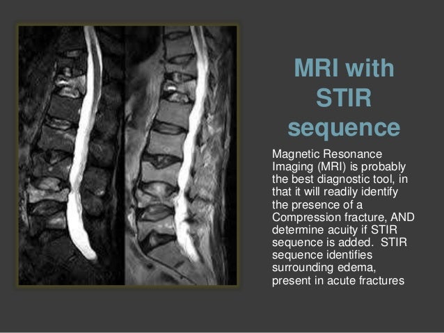 Spinal compression fractures