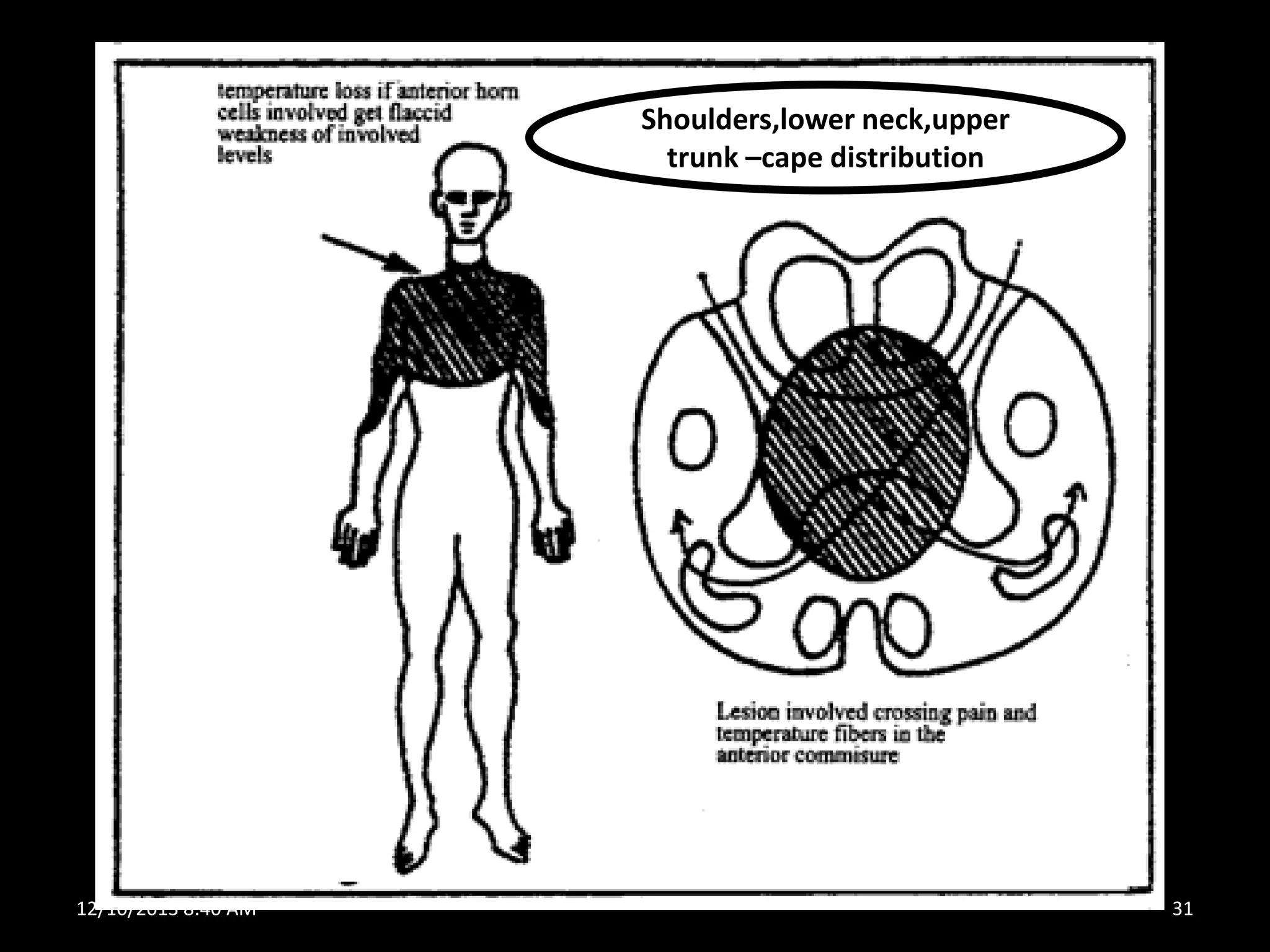 Shoulders,lower neck,upper
trunk –cape distribution

12/10/2013 8:40 AM

31

 