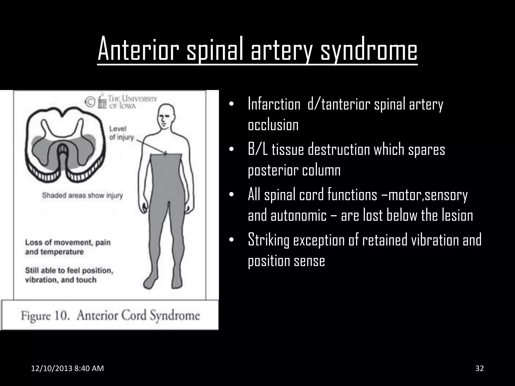 Anterior spinal artery syndrome
• Infarction d/tanterior spinal artery
occlusion
• B/L tissue destruction which spares
posterior column
• All spinal cord functions –motor,sensory
and autonomic – are lost below the lesion
• Striking exception of retained vibration and
position sense

12/10/2013 8:40 AM

32

 