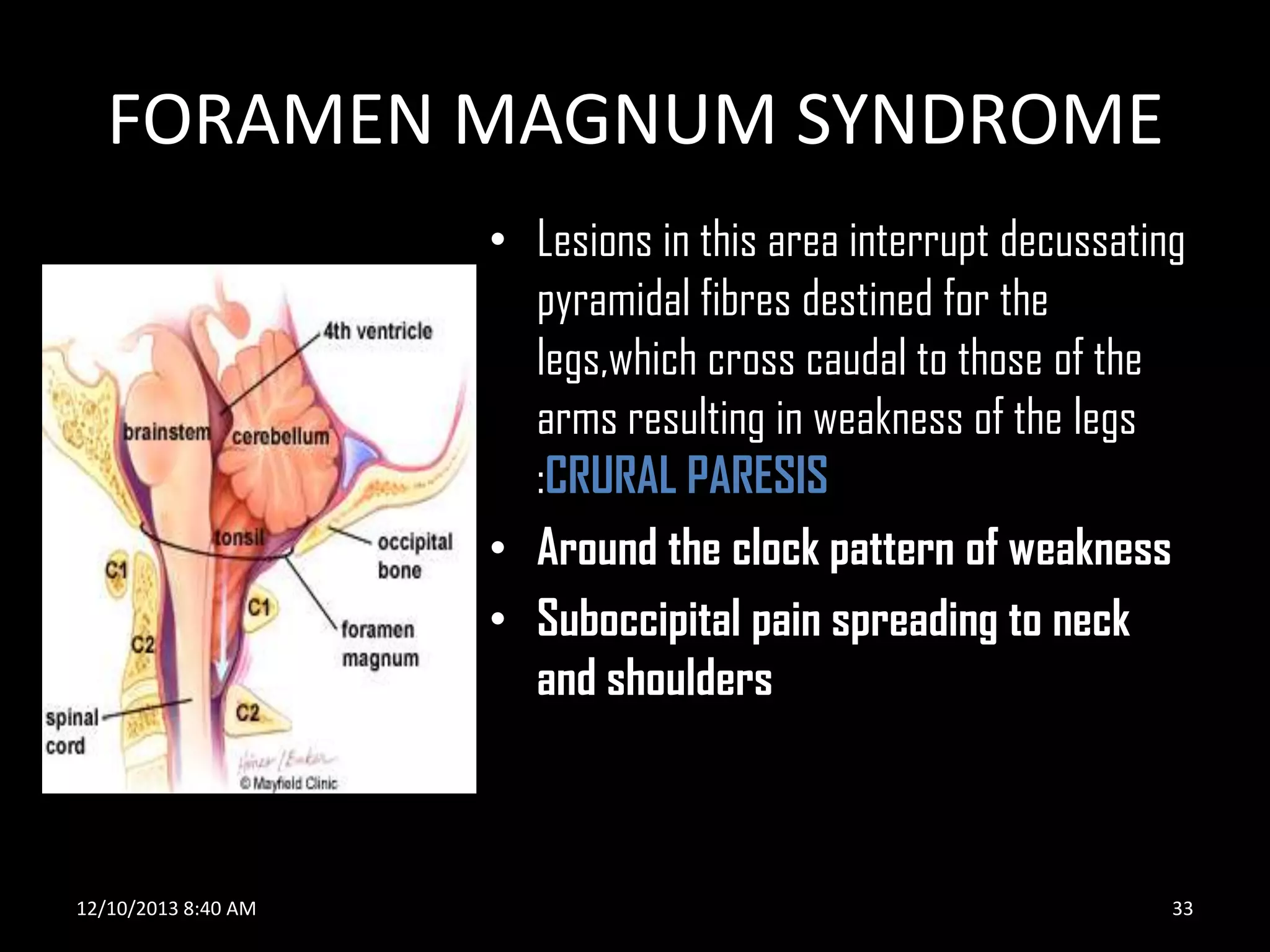 FORAMEN MAGNUM SYNDROME
• Lesions in this area interrupt decussating
pyramidal fibres destined for the
legs,which cross caudal to those of the
arms resulting in weakness of the legs
:CRURAL PARESIS
• Around the clock pattern of weakness
• Suboccipital pain spreading to neck
and shoulders

12/10/2013 8:40 AM

33

 
