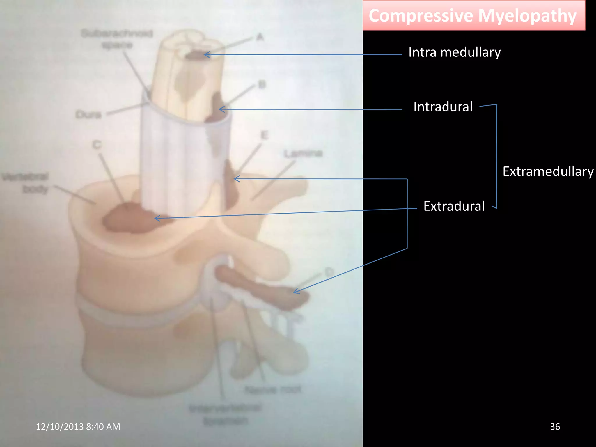 Compressive Myelopathy
Intra medullary

Intradural

Extramedullary
Extradural

12/10/2013 8:40 AM

36

 