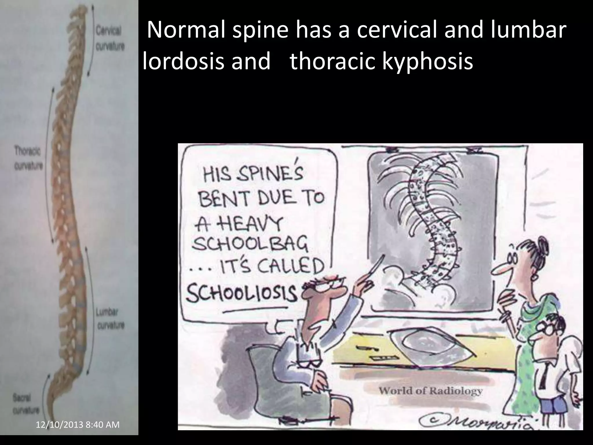 •

12/10/2013 8:40 AM

Normal spine has a cervical and lumbar
lordosis and thoracic kyphosis

4

 