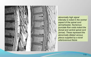 119
abnormally high signal
intensity is noted in the central
aspect of the spinal cord
(arrowheads). Numerous
punctate flow voids indent the
dorsal and ventral spinal cord
(arrow). These represent the
abnormally dilated venous
plexus supplied by a dural
arteriovenous fistula
 