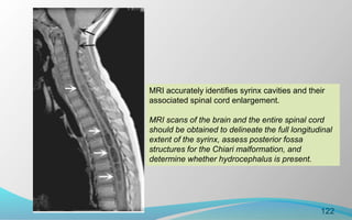 122
MRI accurately identifies syrinx cavities and their
associated spinal cord enlargement.
MRI scans of the brain and the entire spinal cord
should be obtained to delineate the full longitudinal
extent of the syrinx, assess posterior fossa
structures for the Chiari malformation, and
determine whether hydrocephalus is present.
 