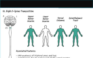 Due to extension of the lesion, long tract
sensory findings, and bladder disturbance, CN
(IX–XII) palsies.
 May compromise CN XI, resulting in
anomalous head position, weakness of the
SCM and trapezius muscle.
 Lower cervical and upper thoracic LMN signs,
due to venous congestion/anterior spinal
artery compression affecting the more caudal
anterior horns.
Causes:
Extramedullary
Meningioma, neurofibroma,
glioma,
Spondylosis,
Chiari malformation, and
trauma;
Intramedullary etiologies
include:
Syringomyelia, MS, and
NMO.
 