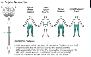  T9 –T10 lesions affect the lower abdominal reflex, but upper and middle
abdominal reflexes are spared.
 T10 lesion is characterized by a Beevor's sign:
 With neck flexion at supine, preserved upper abdominal muscles will pull
the umbilicus upward.
 