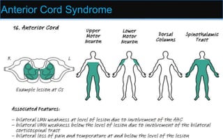 Anterior Cord Syndrome
51
Damage to the anterolateral pathways:
Loss of pain and T° below the lesion,
Damage to the anterior horn cells
LMN weakness at the level of the lesion.
With larger lesions, the lateral corticospinal tracts
may also be involved, causing UMN signs.
Autonomic disturbance
Common causes include anterior spinal artery
infarct, trauma, multiple sclerosis.
 