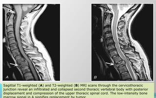69
Sagittal T1-weighted (A) and T2-weighted (B) MRI scans through the cervicothoracic
junction reveal an infiltrated and collapsed second thoracic vertebral body with posterior
displacement and compression of the upper thoracic spinal cord. The low-intensity bone
 