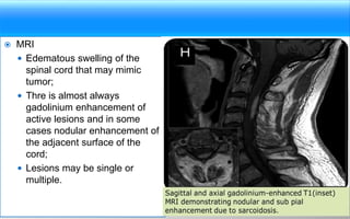  MRI
 Edematous swelling of the
spinal cord that may mimic
tumor;
 Thre is almost always
gadolinium enhancement of
active lesions and in some
cases nodular enhancement of
the adjacent surface of the
cord;
 Lesions may be single or
multiple.
87
 