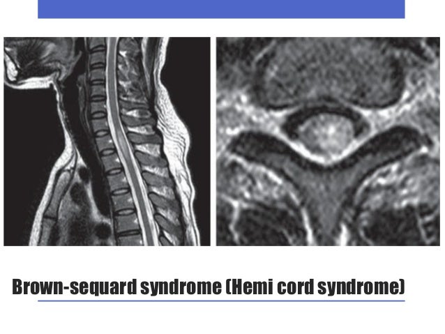 Diseases of Spinal Cord