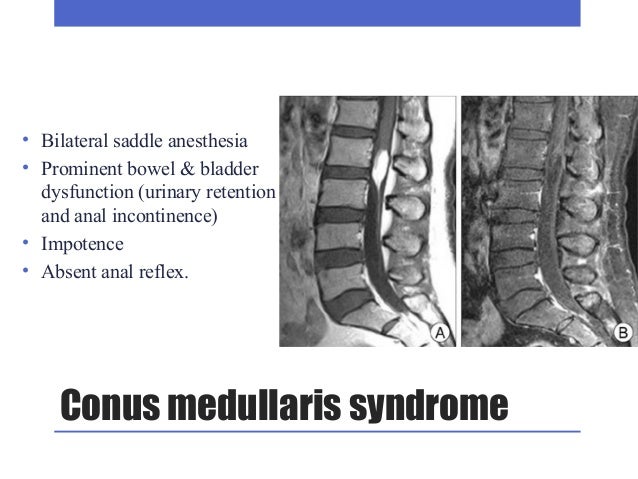 Diseases of Spinal Cord diagram of feet pain 
