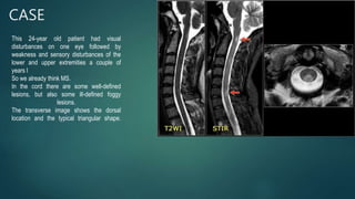 CASE
This 24-year old patient had visual
disturbances on one eye followed by
weakness and sensory disturbances of the
lower and upper extremities a couple of
years l
So we already think MS.
In the cord there are some well-defined
lesions, but also some ill-defined foggy
lesions.
The transverse image shows the dorsal
location and the typical triangular shape.
 