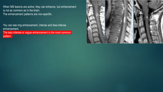 When MS lesions are active, they can enhance, but enhancement
is not as common as in the brain.
The enhancement patterns are non-specific.
You can see ring enhancement, intense and less-intense
enhancement.
The less intense or vague enhancement is the most common
pattern.
 