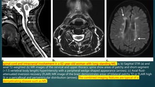 spinal cord and intracranial involvement in a 62-year-old woman with long-standing MS. (a, b) Sagittal STIR (a) and
axial T2-weighted (b) MR images of the cervical and upper thoracic spine show areas of patchy and short-segment
(<1.5 vertebral body length) hyperintensity with a peripheral wedge-shaped appearance (arrows). (c) Axial fluid-
attenuated inversion-recovery (FLAIR) MR image of the brain demonstrates areas of bilateral patchy T2 or FLAIR high
SI in a pericallosal and periventricular distribution (arrows). The combined imaging features are typical of a
demyelinating disease such as MS
 