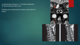 Longitudinally extensive (> 3 vertebral segments)
T2 hyperintensity within cord
+
Swelling and enhancement of optic nerves (85% of
cases)
 
