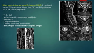 Bright spotty lesions are a specific feature of NMO. It consists of
marked T2 hyperintense (higher than CSF) and T1 hypointense
foci in the central grey matter.
T1 C+ (Gd)
•enhancement is common and variable in
appearance
• ring-enhancement
• patchy "cloud-like" enhancement
•lens-shaped enhancement on sagittal images
 