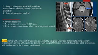 ADEM in child with acute onset of weakness. (a) Sagittal T2-weighted MR image demonstrates long-segment
hyperintensity (arrows) with expansion. (b) Axial FLAIR image of the brain demonstrates variable sized large lesions
with involvement of the pons and basal ganglia.).
Long cord segment lesion with associated
multifocal brain affection “WM, BG , thalamus &
brain stem”.
Brain almost always involved
Enhancement Pattern
 Variable appearance
 No enhancement in up to 40-50% cases
 Enhancement more common when cord enlargement present
 
