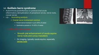 NB : Guillain barre syndrome
• Autoimmune postinfectious or postvaccinial acute
inflammatory demyelination of peripheral nerves, nerve roots,
cranial nerves
• c/p : Ascending paralysis
 Cranial nerve involvement common
 Facial nerve involved in up to 50% of cases
 Ophthalmo-paresis in 10-20% of cases
 MRI LSS with contrast
• Smooth pial enhancement of cauda equina
nerve roots and conus medullaris
• On imaging, typically cauda equina, especially
ventral roots
 
