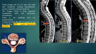 These images are of a 31 year old male
with headache, voiding disturbances,
urinary retention, sensory level C3.
The images show a long segment
myelopathy with full transverse
involvement.
There is no swelling and no
enhancement.
It does not look like MS or tumor, so we
are thinking ATM - acute transverse
myelitis.
 