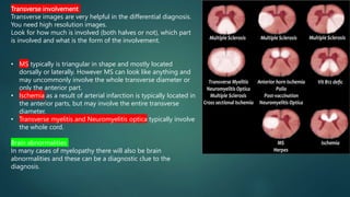 Transverse involvement
Transverse images are very helpful in the differential diagnosis.
You need high resolution images.
Look for how much is involved (both halves or not), which part
is involved and what is the form of the involvement.
• MS typically is triangular in shape and mostly located
dorsally or laterally. However MS can look like anything and
may uncommonly involve the whole transverse diameter or
only the anterior part.
• Ischemia as a result of arterial infarction is typically located in
the anterior parts, but may involve the entire transverse
diameter.
• Transverse myelitis and Neuromyelitis optica typically involve
the whole cord.
Brain abnormalities
In many cases of myelopathy there will also be brain
abnormalities and these can be a diagnostic clue to the
diagnosis.
 