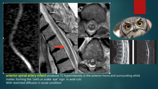 anterior spinal artery infarct produces T2 hyperintensity in the anterior horns and surrounding white
matter, forming the “owl’s or snake eye” sign in axial cuts
With restricted diffusion in acute condition
 