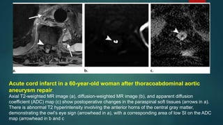 Acute cord infarct in a 60-year-old woman after thoracoabdominal aortic
aneurysm repair.
Axial T2-weighted MR image (a), diffusion-weighted MR image (b), and apparent diffusion
coefficient (ADC) map (c) show postoperative changes in the paraspinal soft tissues (arrows in a).
There is abnormal T2 hyperintensity involving the anterior horns of the central gray matter,
demonstrating the owl’s eye sign (arrowhead in a), with a corresponding area of low SI on the ADC
map (arrowhead in b and c
 