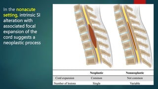 In the nonacute
setting, intrinsic SI
alteration with
associated focal
expansion of the
cord suggests a
neoplastic process
 