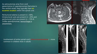 As astrocytomas arise from cord
parenchyma (cf. ependymomas that arise in
the central canal), they typically have an
eccentric location within the spinal cord.
Peritumoral edema is present in ~40%.
Intratumoral cysts are present in ~20% and
peritumoral cysts are present in ~15% 8.
Unlike ependymomas, hemorrhage is
uncommon.
involvement of entire spinal cord (holocord presentation) - more
common in children than in adults
 