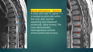 Spinal astrocytoma - thoracic
A mass with high T2 signal ( * )
is located eccentrically within
the cord, with 'normal'
appearing cord displaced
posteriorly (blue arrows). The
mass demonstrates
heterogeneous contrast
enhancement (red arrows).
 