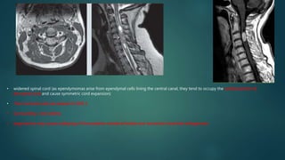 • widened spinal cord (as ependymomas arise from ependymal cells lining the central canal, they tend to occupy the central portion of
the spinal cord and cause symmetric cord expansion)
• Non-tumoral cysts are present in 62% 5
• Surrounding cord odema
• large lesions may cause scalloping of the posterior vertebral bodies and neural exit foraminal enlargement
 
