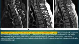 Cord ependymoma in a 25-year-old woman with a history of neurofibromatosis type 2 who presented with progressive
back pain and leg numbness. Sagittal STIR (a), T1-weighted (b), and contrast-enhanced T1-weighted (c) MR images
demonstrate a heterogeneous mildly enhancing intramedullary lesion in the upper thoracic cord, causing cord
expansion (arrow). The mass shows hemorrhagic products along the inferior aspect (arrowhead in a), demonstrating the
hemosiderin cap sign
 