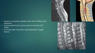 • Appears as discrete nodules, there can be diffuse cord
expansion
• An associated tumor cyst or syrinx is common (50-
100%)
• In T2 associate focal flow voids especially in larger
lesions
 