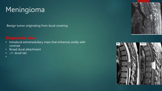 Meningioma
Benign tumor originating from dural covering
Diagnostic clue
• Intradural extramedullary mass that enhances avidly with
contrast
• Broad dural attachment
• -/+ dural tail
•
 