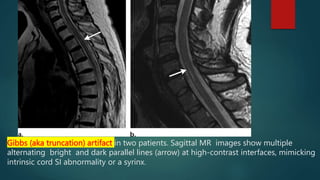 Gibbs (aka truncation) artifact in two patients. Sagittal MR images show multiple
alternating bright and dark parallel lines (arrow) at high-contrast interfaces, mimicking
intrinsic cord SI abnormality or a syrinx.
 