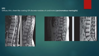 MRI
Diffuse, thin, sheet-like coating OR discrete nodules of cord/roots (carcinomatous meningitis)
 