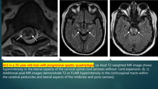 ALS in a 35-year-old man with progressive spastic quadriplegia. (a) Axial T2-weighted MR image shows
hyperintensity in the lateral aspects of the cervical spinal cord (arrows) without cord expansion. (b, c)
Additional axial MR images demonstrate T2 or FLAIR hyperintensity in the corticospinal tracts within
the cerebral peduncles and lateral aspects of the midbrain and pons (arrows).
 