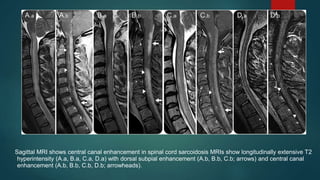Sagittal MRI shows central canal enhancement in spinal cord sarcoidosis MRIs show longitudinally extensive T2
hyperintensity (A.a, B.a, C.a, D.a) with dorsal subpial enhancement (A.b, B.b, C.b; arrows) and central canal
enhancement (A.b, B.b, C.b, D.b; arrowheads).
 