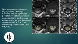 Axial postgadolinium images
highlight the trident sign
Crescent-shaped layering of
posterior subpial enhancement
accompanied by central canal
enhancement led to a 3-pronged
appearance (A.a, B.a, C.a)
resembling a trident head (A.b,
B.b, C.b).
 