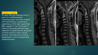 Radiation myelitis
55 years old men followed since 2
years for undifferenciated
nasopharyngeal carcinoma treated
with radiotherapy consulting for
paresthesia of the right upper limb.
MRI : sagittal T1 (a), T2 (b) and T1
Gado (c): showing extensive long-
segment T2 hyperintensity along the
cervical cord and cranio-cevical
junction with fatty bone marrow
replacement in the corresponding
vertebral bodies
 