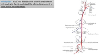 Poliomyelitis : It is a viral disease which involves anterior horn
cells leading to flaccid paralysis of the affected segments. It is
lower motor neuron paralysis
 