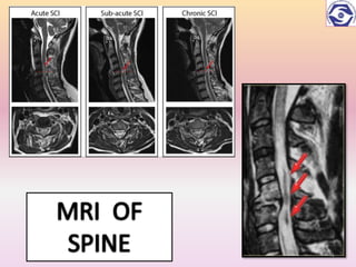SPINAL CORD INJURIES AND PT REHABILITATION | PPTX