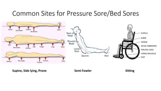 Common Sites for Pressure Sore/Bed Sores
Supine, Side lying, Prone SittingSemi Fowler
 